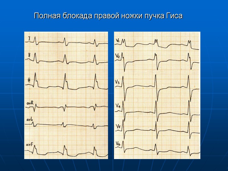 Полная блокада правой ножки пучка Гиса